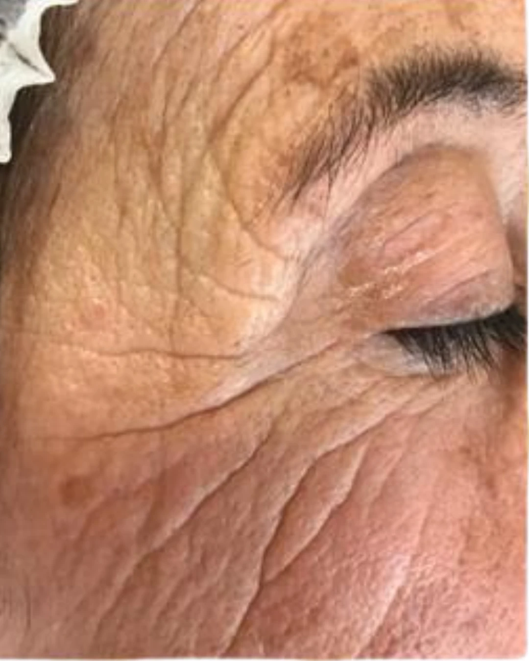 arrugas_before