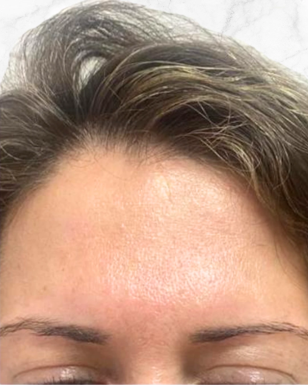 botox_after