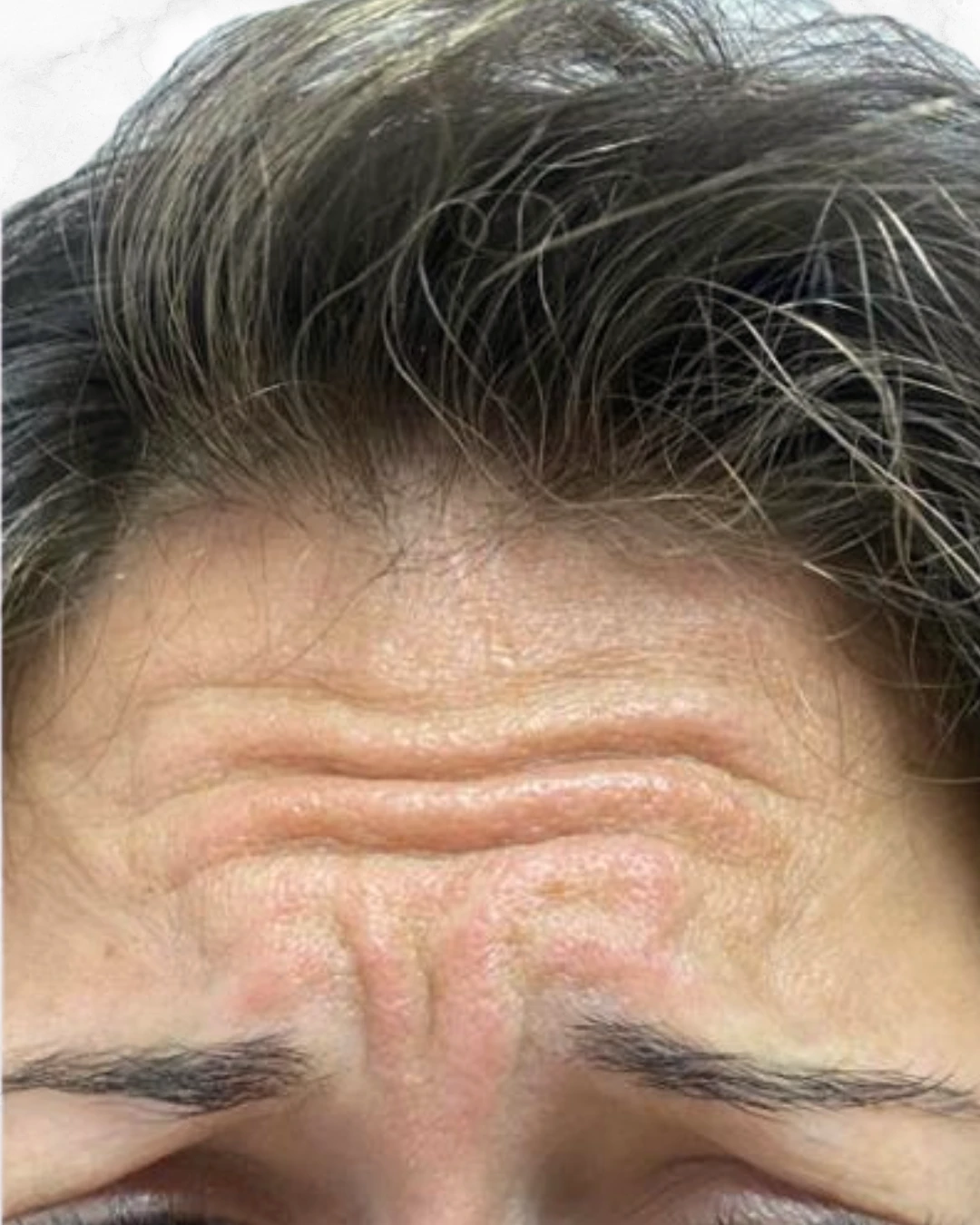 botox_before